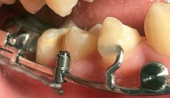 Lückenschluss im Unterkiefer mit CAD/CAM-Mesialslider und Alignern