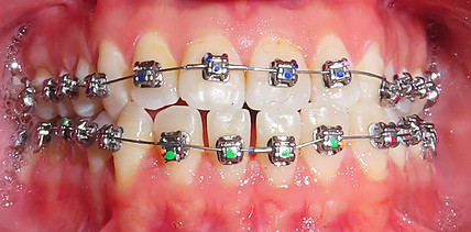 Möglichkeiten und Grenzen der kieferorthopädischen Camouflage-Behandlung