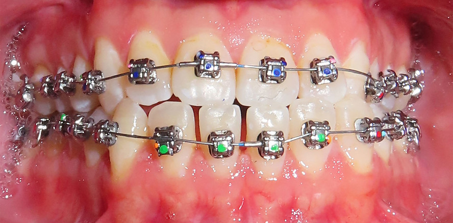 Möglichkeiten und Grenzen der kieferorthopädischen Camouflage-Behandlung