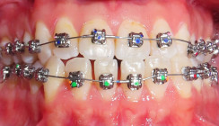 Möglichkeiten und Grenzen der kieferorthopädischen Camouflage-Behandlung