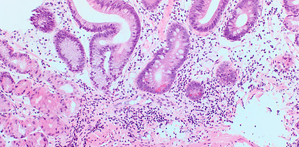 Malnutrition im Senium Ursache und Folge dieser Störung im oralen Mikrobiom