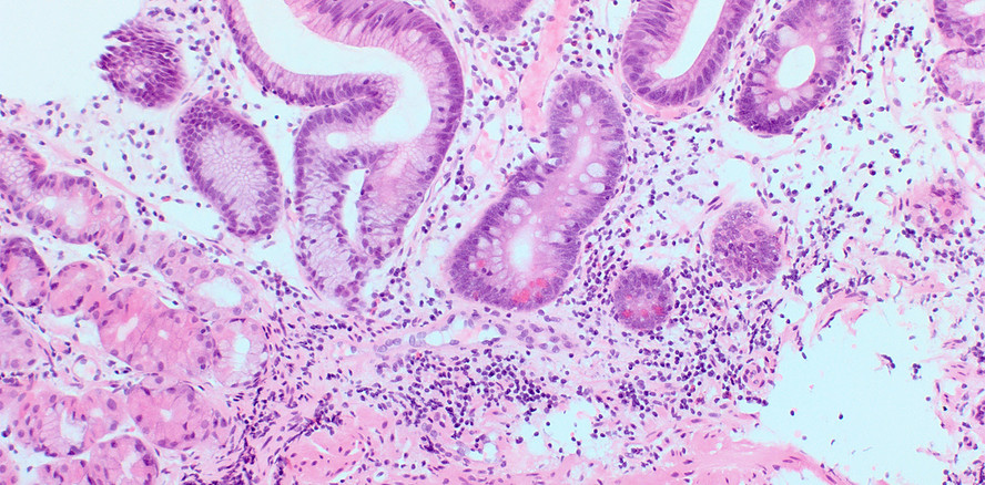 Malnutrition im Senium Ursache und Folge dieser Störung im oralen Mikrobiom