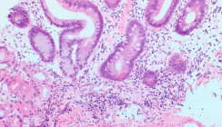 Malnutrition im Senium Ursache und Folge dieser Störung im oralen Mikrobiom