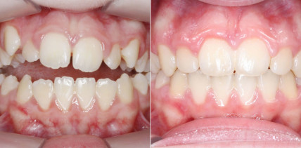 Mehrfachnutzung palatinaler Miniimplantate: Oberkieferexpansion und Molarenintrusion
