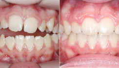 Mehrfachnutzung palatinaler Miniimplantate: Oberkieferexpansion und Molarenintrusion