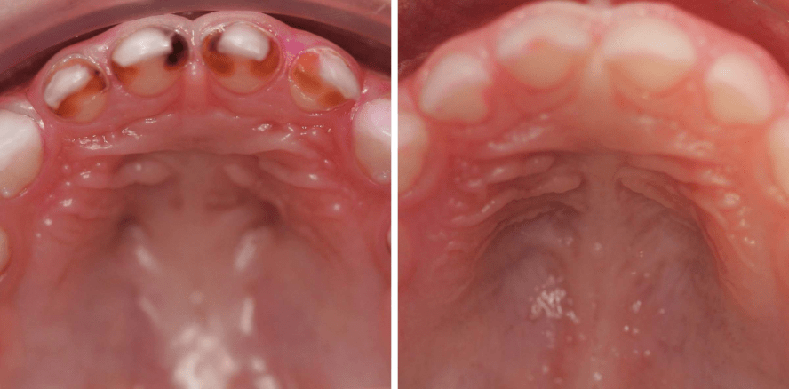 Vererbung von Karies, Parodontitis und Co. – ein Mythos?