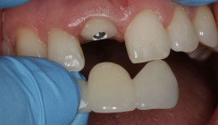 Miesbacher Konzept zur Sofortimplantation