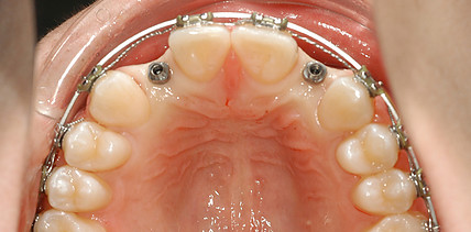 Miniimplantate als temporärer Zahnersatz – Tipps und klinische Erfahrungen aus 20 Jahren