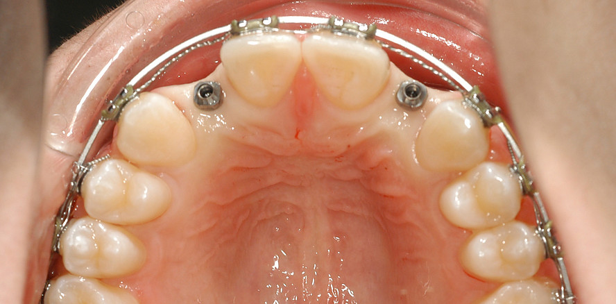 Miniimplantate als temporärer Zahnersatz – Tipps und klinische Erfahrungen aus 20 Jahren