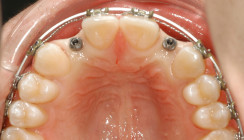 Miniimplantate als temporärer Zahnersatz – Tipps und klinische Erfahrungen aus 20 Jahren