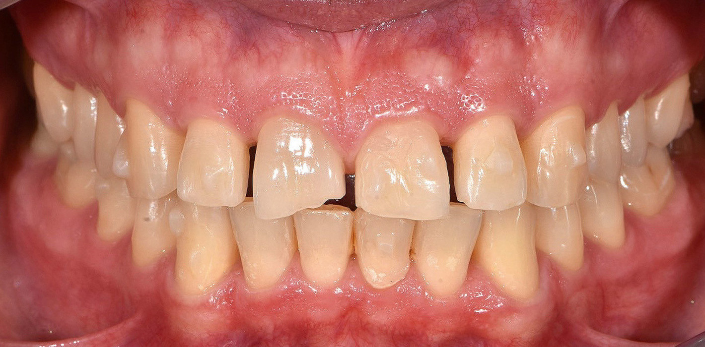 Minimalinvasive Behandlung mit Alignern und Veneers