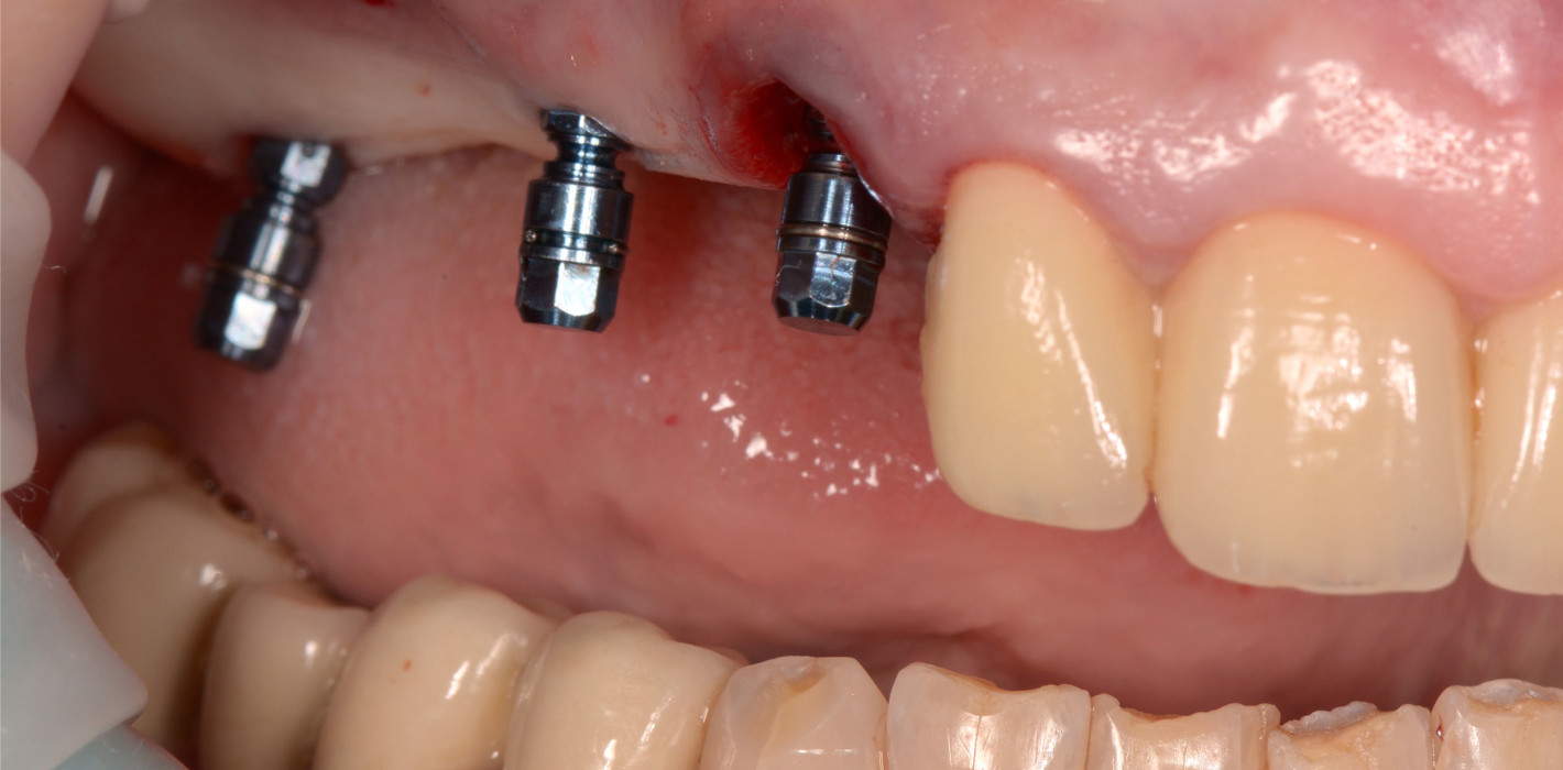 Minimalinvasive Implantation mit digitaler Vorplanung