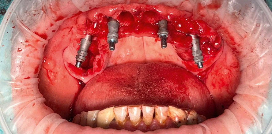 Minimalinvasive Implantologie in der Praxis