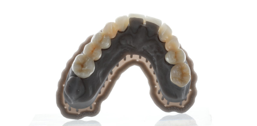 Minimalinvasive Zirkondioxidrestauration – Teil 2