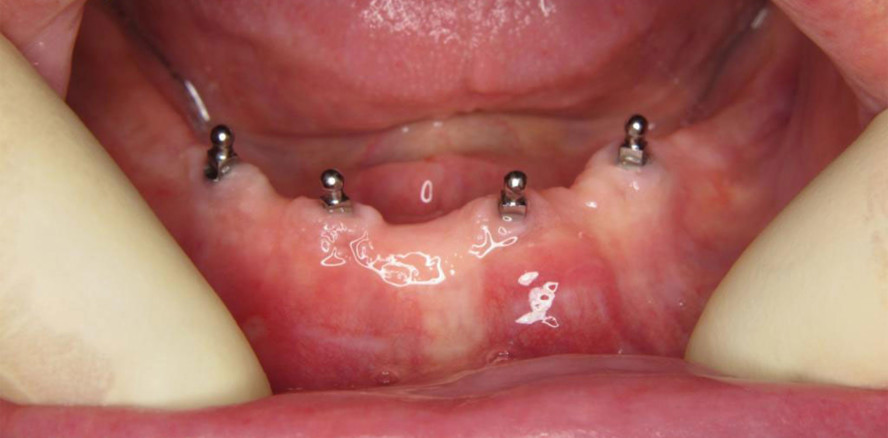 Minimalinvasives Vorgehen bei geriatrischen Patienten