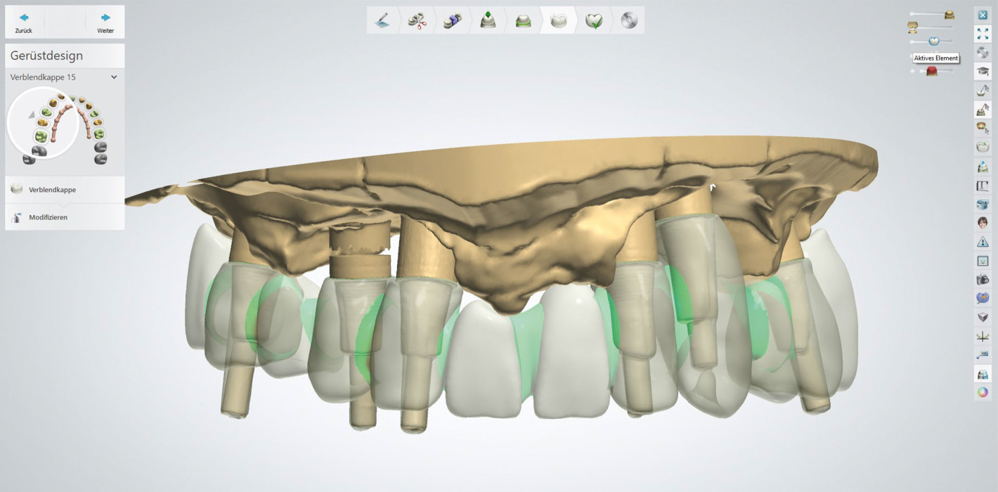 Neuversorgung angulierter Oberkieferimplantate