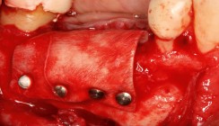Nicht immer geht es minimalinvasiv – Implantation mit Nervverlagerung