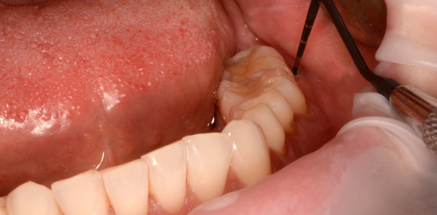 Nichtchirurgische Therapie tiefer PA-Defekte mit NaOCl-Gel und vernetzter Hyaluronsäure