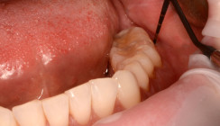 Nichtchirurgische Therapie tiefer PA-Defekte mit NaOCl-Gel und vernetzter Hyaluronsäure