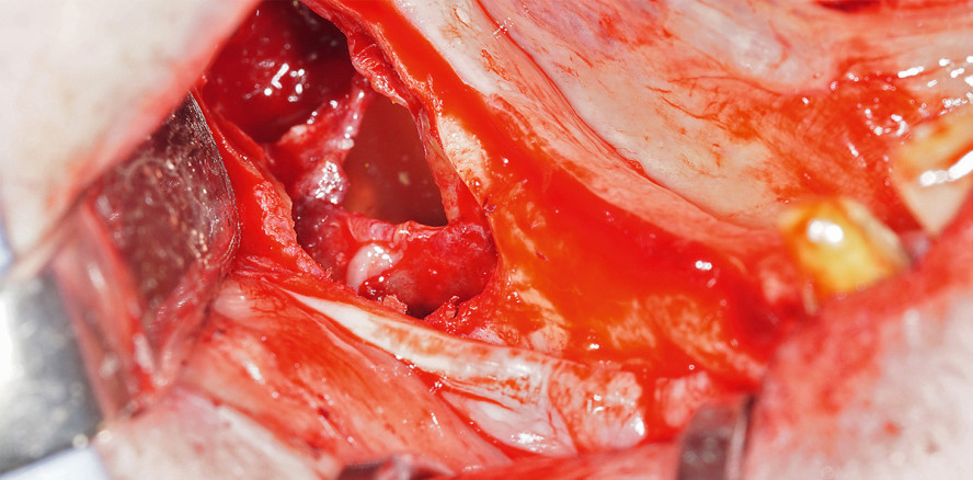 Entfernung eines keratozystischen odontogenen Tumors