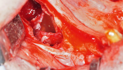 Entfernung eines keratozystischen odontogenen Tumors