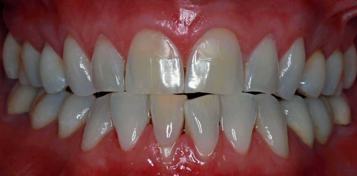 OK-Frontversorgung mit Feldspatkeramik-Veneers trotz Parafunktion (Teil 1)