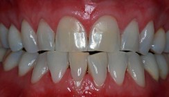OK-Frontversorgung mit Feldspatkeramik-Veneers trotz Parafunktion (Teil 1)