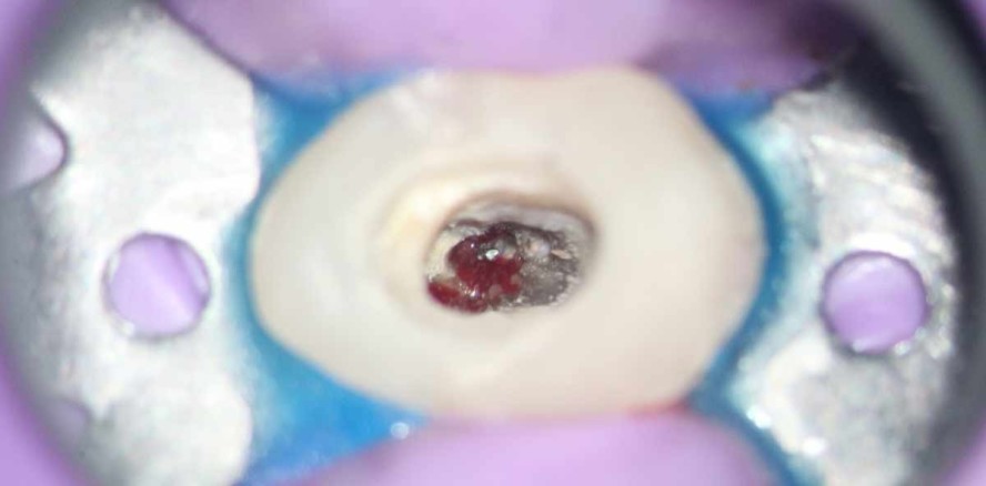 Instrumentenbruch: Therapie eines Oberkieferprämolaren