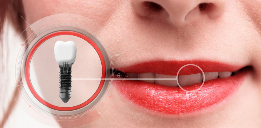 Welche Fragen sind noch offen in der Implantologie?