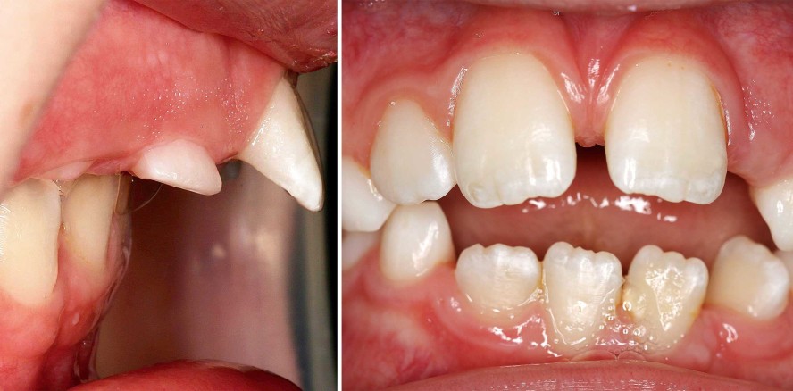 Optimaler Behandlungszeitpunkt und Überweisung zum Kieferorthopäden