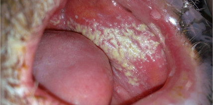 Orale Candidose – ihre lokalen und systemischen Folgen