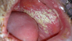 Orale Candidose – ihre lokalen und systemischen Folgen