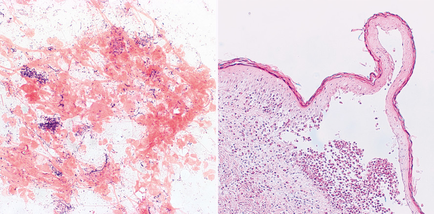 Hat Parodontitis eine autoimmune Komponente?