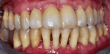 Gelockerte Zähne aufgrund von Parodontitis – Schienung oder Extraktion?