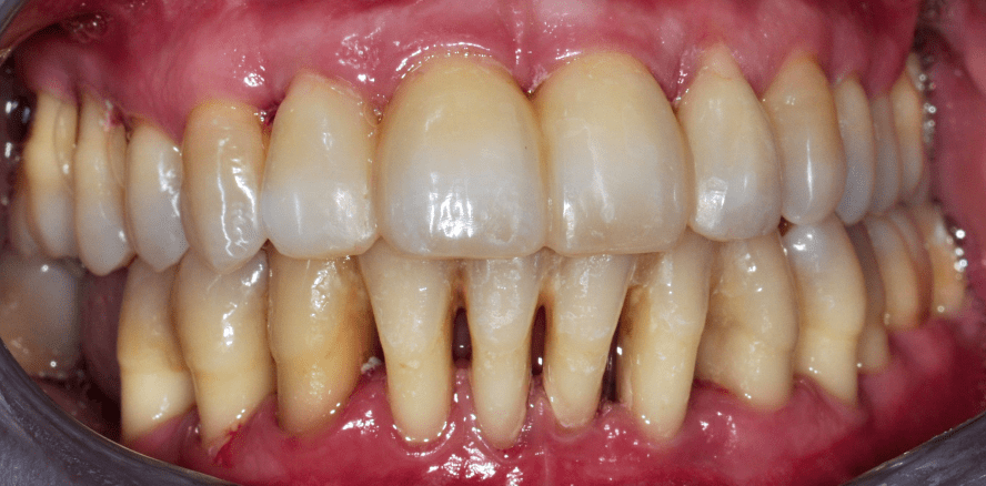 Gelockerte Zähne aufgrund von Parodontitis – Schienung oder Extraktion?