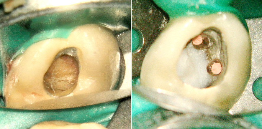 Perforation des Pulpabodens eines Brückenpfeilerzahns