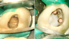 Perforation des Pulpabodens eines Brückenpfeilerzahns