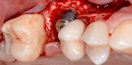 Periimplantäre Knochenregeneration mit Implantat- und Prothetikerhalt
