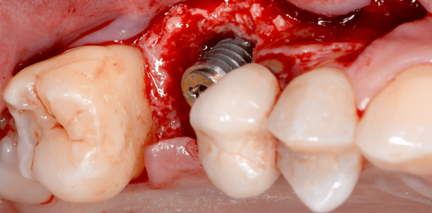 Periimplantäre Knochenregeneration mit Implantat- und Prothetikerhalt