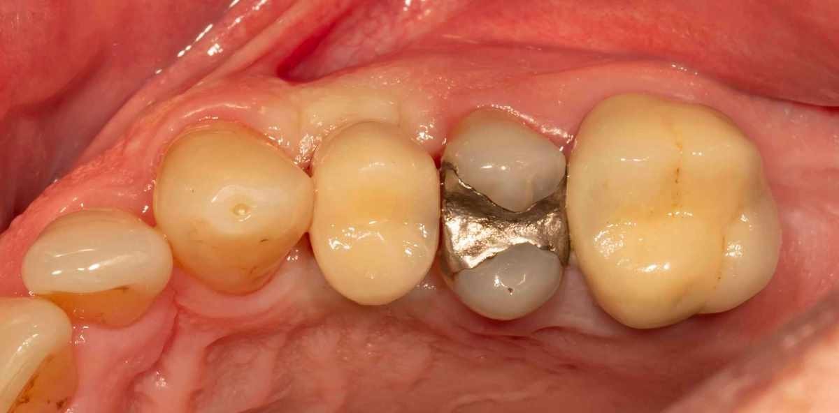 Biologische Strategien zum periimplantären Gewebserhalt