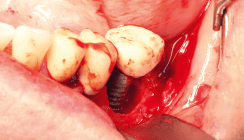 Periimplantitis – geht es auch ohne Operation?