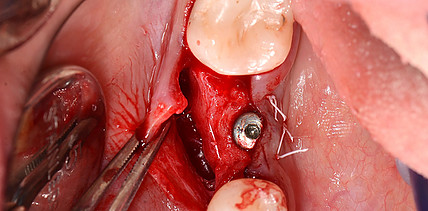 Periostbasierte Regenerationstechnik zur alveolären Knochenaugmentation
