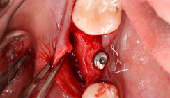 Periostbasierte Regenerationstechnik zur alveolären Knochenaugmentation