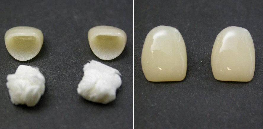 Polieren von zirkonoxidverstärkten Lithiumsilikatkronen