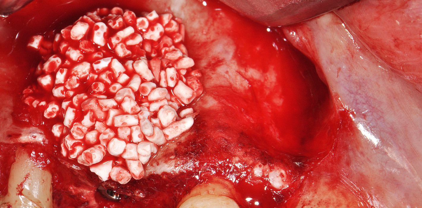 Augmentation mit biphasischem, phykogenem KAM