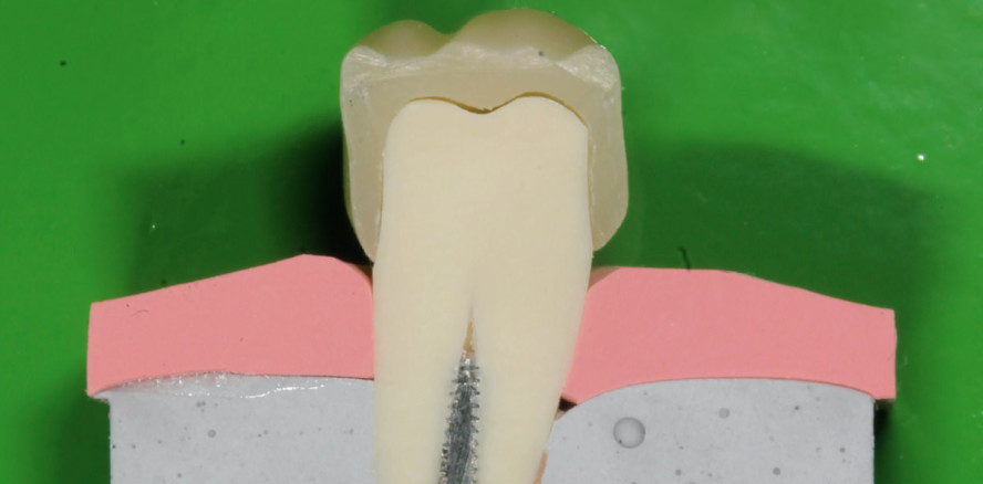 Führungsstifte als Präparationshilfen für Vollkeramikkronen