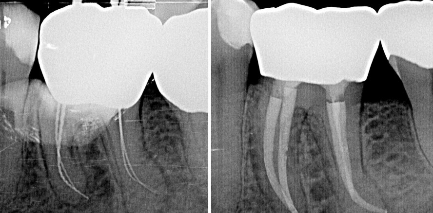 Akute Exazerbation: Primäre endodontische Behandlung