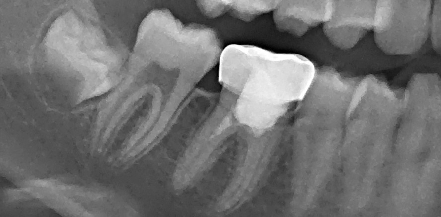 Regenerative Endodontie – auch langfristig erfolgreich?