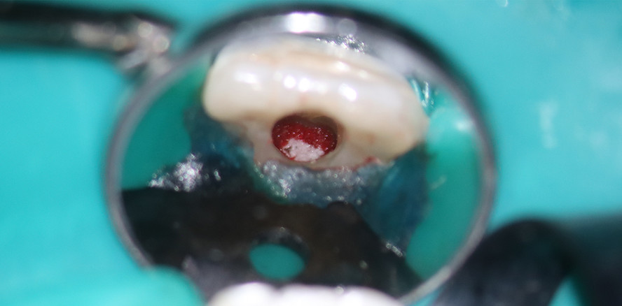 Regenerative Endodontie am unreifen permanenten Inzisivus