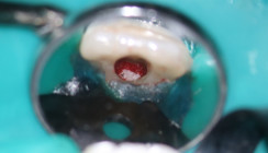 Regenerative Endodontie am unreifen permanenten Inzisivus